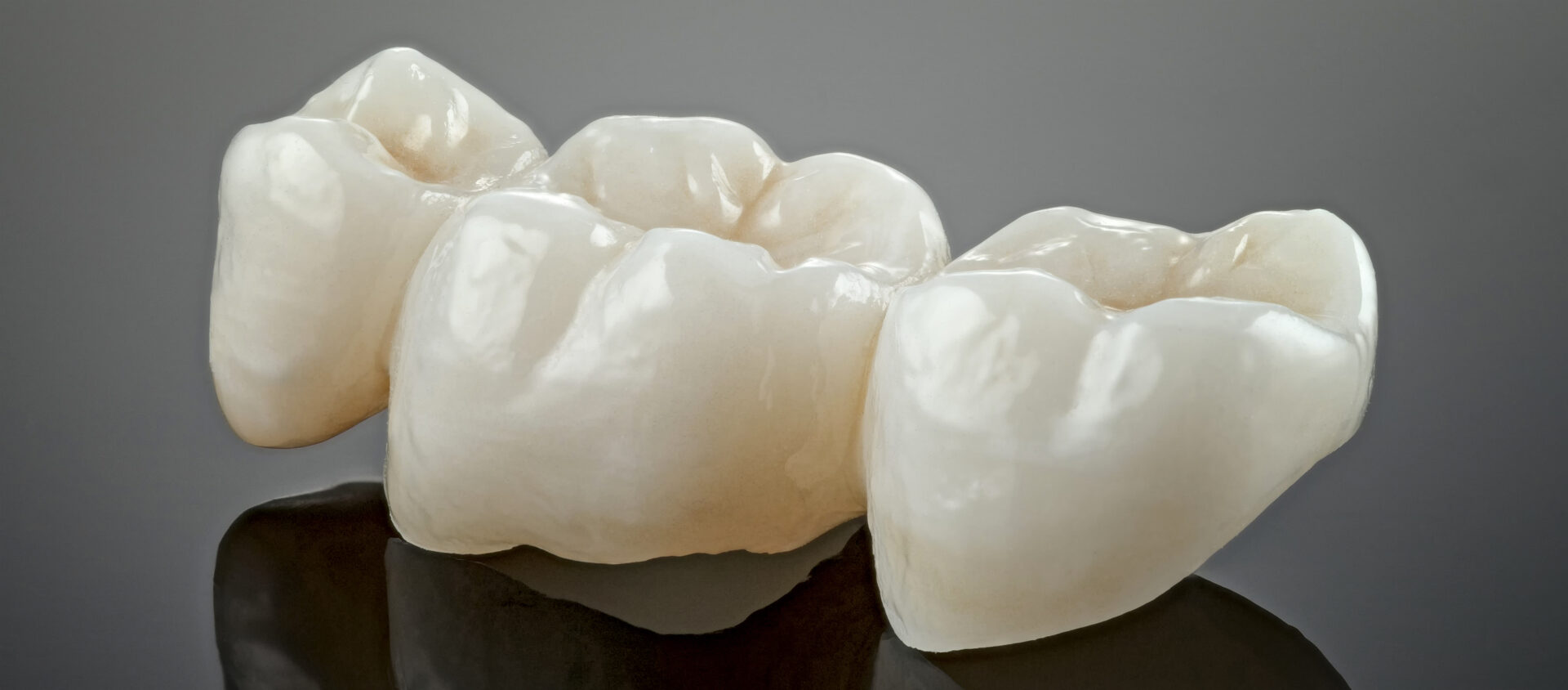 Close-up of tooth-coloured ceramic crowns
